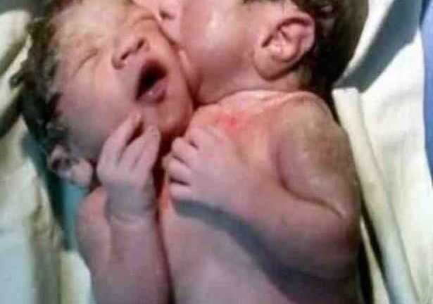 Cặp sinh đôi dính liền có 2 đầu, 3 cánh tay và 4 chân