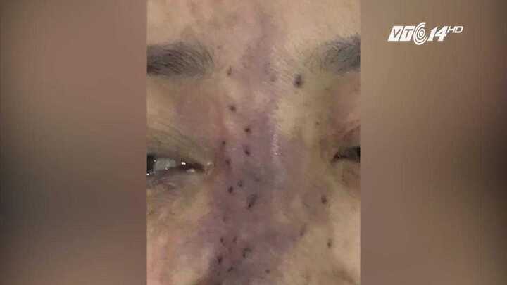 Tiêm chất làm đầy ở viện thẩm mỹ, hỏng má, hoại tử chân mày