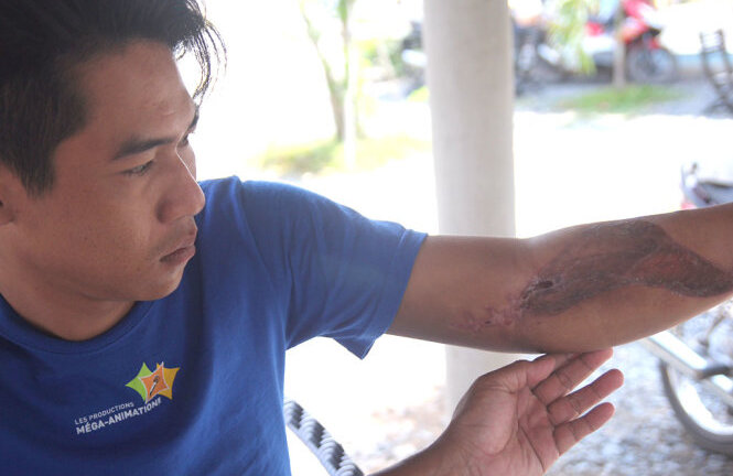 Công an xã bị tố đánh gãy tay nam thanh niên