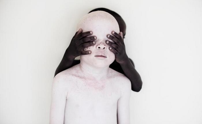 Xót xa số phận những trẻ bạch tạng bị giết hại làm bùa chú và độc dược