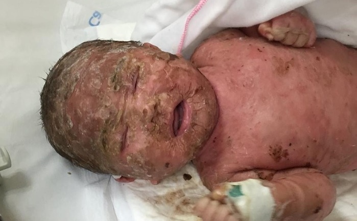 Xót xa bé 4 tháng tuổi nhiễm trùng da do tắm lá