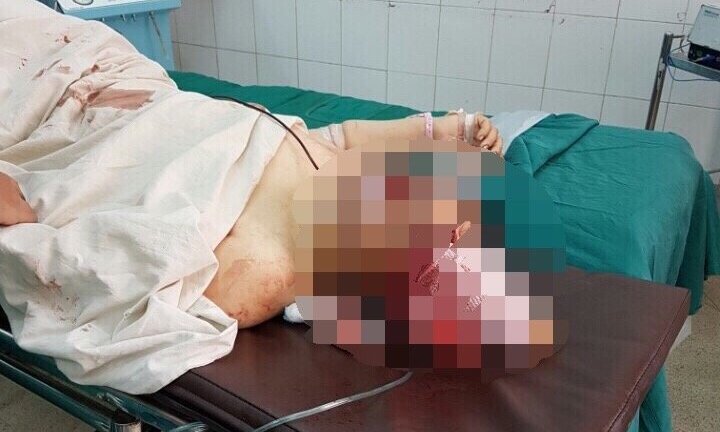 Chồng chém vợ vỡ sọ não rồi cứa cổ tự tử