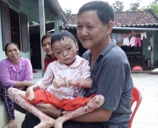 Xót xa bé gái 8 tuổi mắc bệnh lạ chân tay không có ngón, cơ thể phồng rộp, lở loét