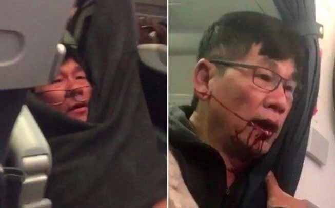 Bác sĩ gốc Việt David Dao bị gãy mũi và răng, phải phẫu thuật chỉnh hình