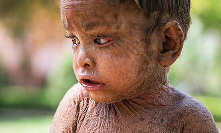 Xót xa bé gái có 'làn da thằn lằn' ở Ấn Độ