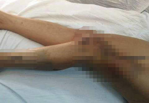 Tránh đống vật liệu bên đường, nữ sinh bị que sắt đâm thấu chân