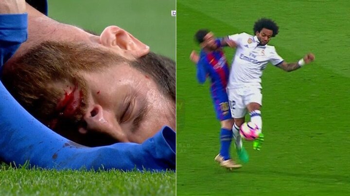 Video: Messi đổ máu sau pha va chạm với Marcelo