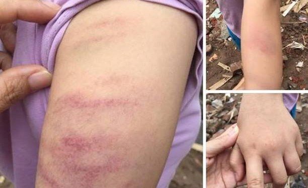 Làm thiếu bài tập, học sinh bị giáo viên đánh bầm tím tay