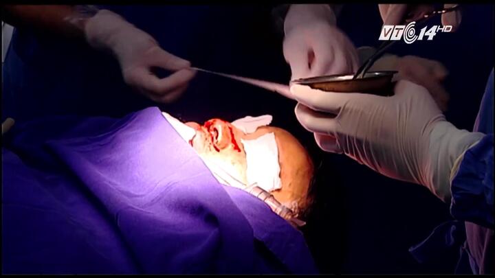 Đang làm việc, công nhân bị lưỡi cưa máy bắn ngang mặt