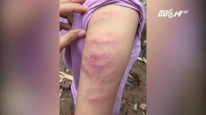 Học sinh không làm bài, bị cô giáo đánh bầm tím: Gia đình đồng ý bỏ qua