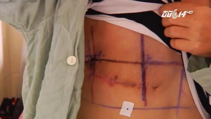 Nhiều cô gái mới 20 tuổi đã mắc ung thư vú