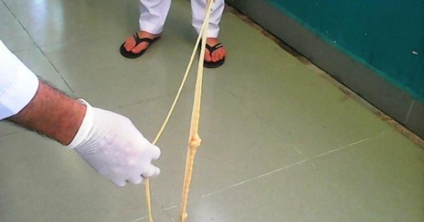 Rùng mình sán xơ mít dài 8m được lấy ra khỏi người bệnh nhân