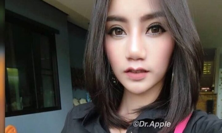 Hoảng hốt với xu hướng làm đẹp môi: Mỏng, dày rồi lại... sừng trâu!