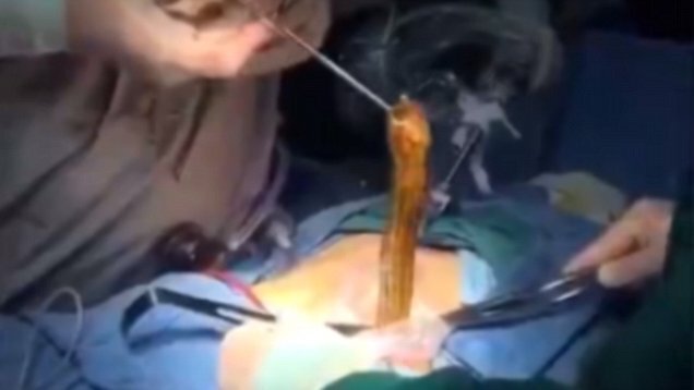 Video: Bác sỹ mổ bụng, cứu người đàn ông nhét lươn qua hậu môn tìm cảm giác lạ