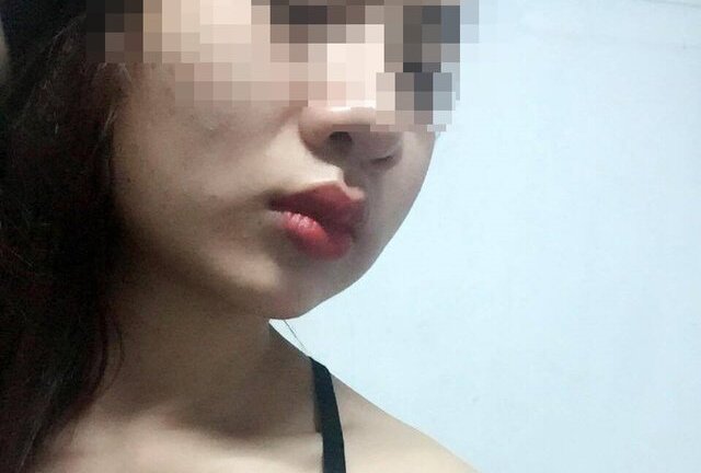 Thiếu nữ xinh đẹp bỗng sưng phù mặt, nổi hạch vì làm má lúm đồng tiền tại nhà