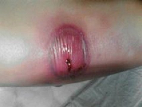 Hà Giang: Điều trị bỏng nước sôi, bé 11 tháng tuổi chết thương tâm vì nhiễm trùng