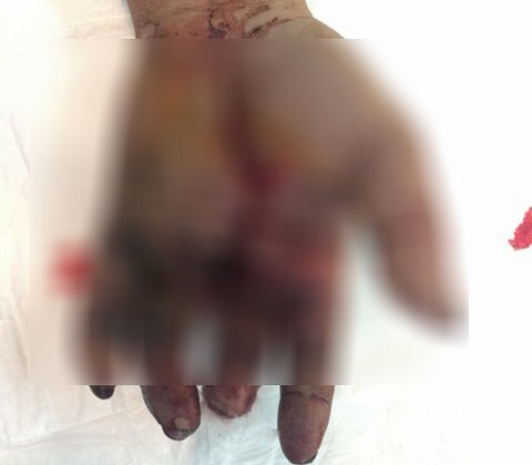 Pin dự phòng phát nổ, người đàn ông bị vỡ toác bàn tay