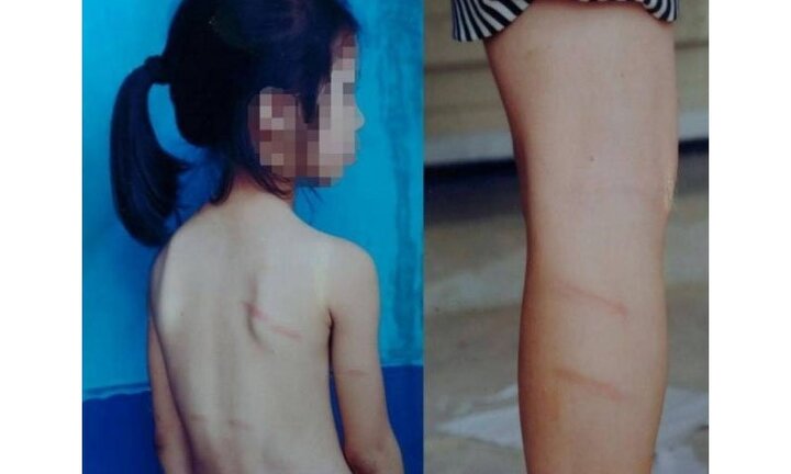 Bé gái lớp 1 bị cô giáo đánh thâm tím vì không làm được bài