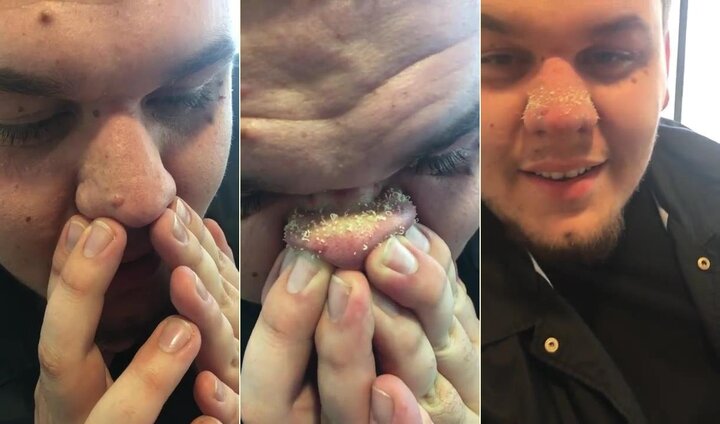 Nổi da gà xem cảnh nặn mụn đầu đen trên mũi