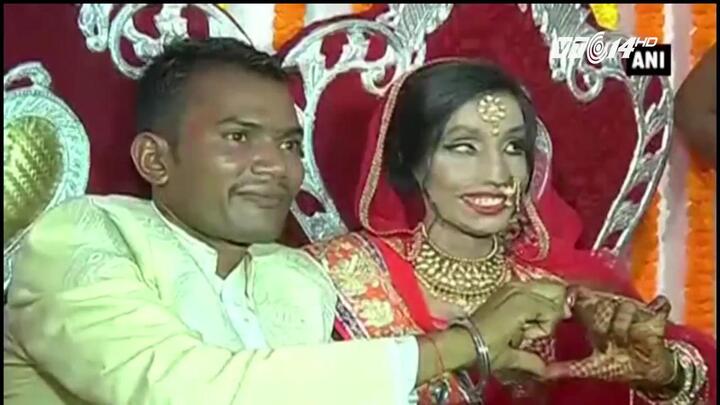 Mặt biến dạng vì bị tạt axit, cô gái không ngờ vẫn có tình yêu đẹp như mơ