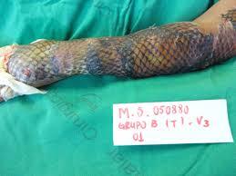 Độc đáo cách chữa bỏng bằng da cá rô phi ở Brazil