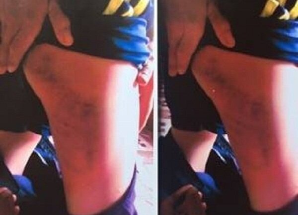 Bé trai 15 tuổi nghi bị công an xã đánh nhập viện do đi cùng bạn trộm xe gắn máy