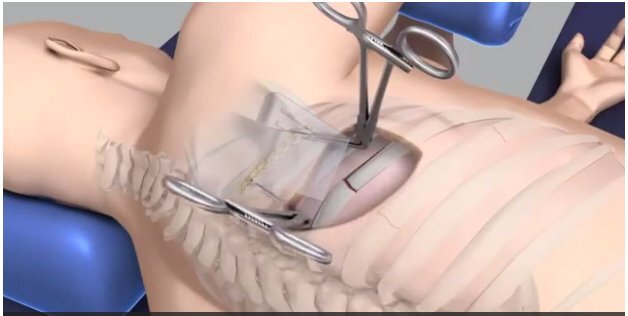 Video: Cận cảnh quy trình nắn lại xương sườn bị gãy cho bệnh nhân