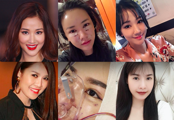7 sao Việt không ngại công khai hình ảnh xấu xí sau khi dao kéo