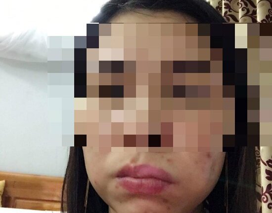 Hà Nội: Làm má lúm đồng tiền, mặt méo xệch đáng sợ