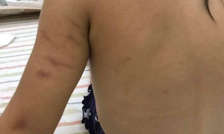 Phụ huynh tố cô giáo đánh bầm tím bé 22 tháng tuổi: Hiệu trưởng nói bé tự cào cấu