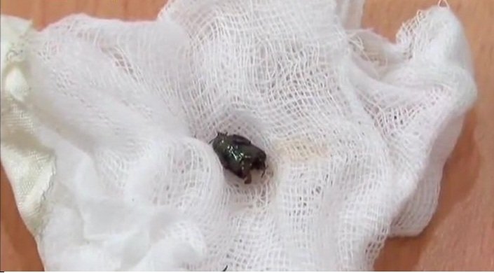 Bị côn trùng dài 2cm chui vào phổi, bé trai suýt mất mạng