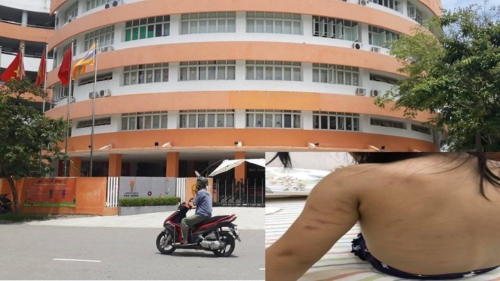 Phụ huynh tố cô giáo đánh bầm tím bé 22 tháng tuổi: Thông tin mới nhất