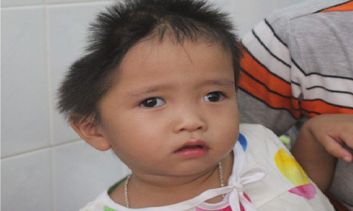 Xót xa bé gái 30 tháng tuổi mang 2 căn bệnh quái ác, đầu bị móp một bên