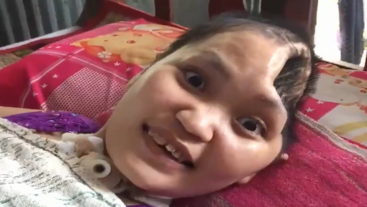 Tận cùng nỗi đau của cô gái mất nửa não, nằm liệt sau tai nạn