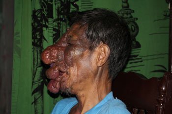 Xót xa người đàn ông mang gương mặt dị dạng đi ăn xin nuôi vợ tàn tật