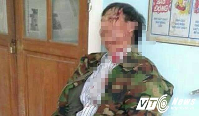 Trưởng công an xã đánh vỡ đầu dân: Kết luận bất ngờ