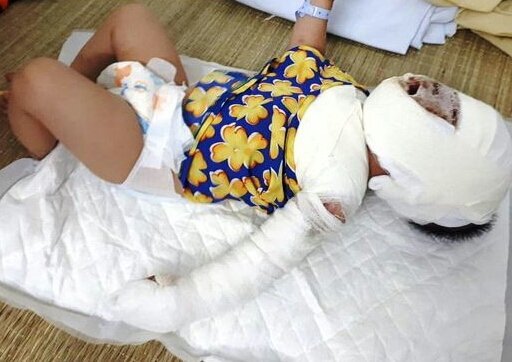Thương tâm bé gái 9 tháng tuổi ngã vào bếp lửa khiến mặt biến dạng