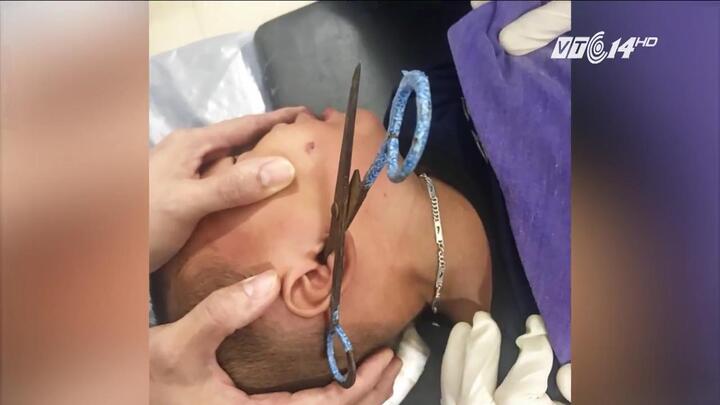 Bé trai gần 3 tuổi bị kéo đâm sâu vào ống tai trong lúc chơi đùa