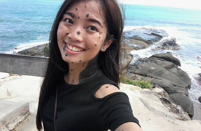 Cô gái có hàng trăm nốt ruồi giăng kín người vẫn tự tin đi thi Hoa hậu hoàn vũ