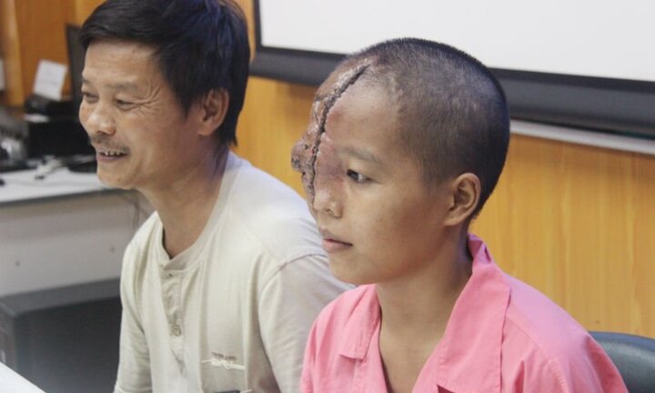 Cô gái 21 năm mang khối bướu máu khổng lồ trên mặt