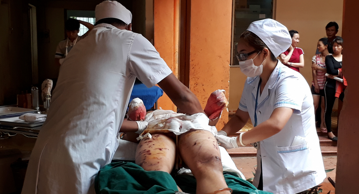 Bình phân bón phát nổ, thiếu niên phải cắt bỏ 2 bàn tay