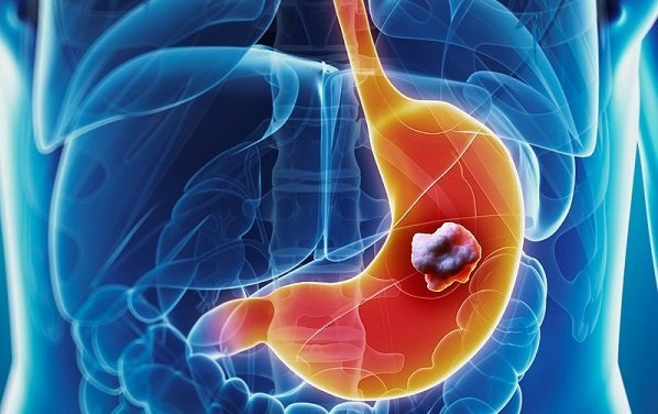 Miễn phí xét nghiệm dấu ấn ung thư dạ dày với tất cả người dân