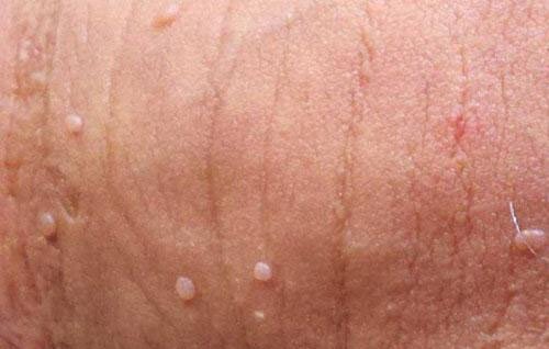 Bệnh sùi mào gà và những điều phụ huynh ít biết