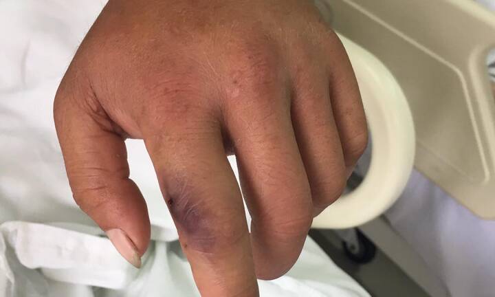 Mải chữa vết rắn cắn bằng thuốc nam, đến viện đã tử vong