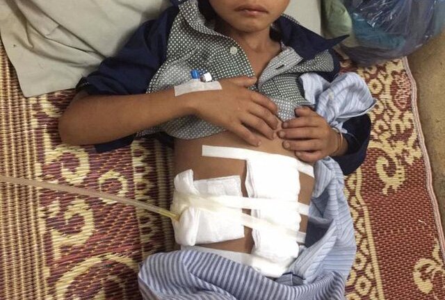 Cậu bé 10 tuổi bị trâu húc vỡ ruột non ở Yên Bái