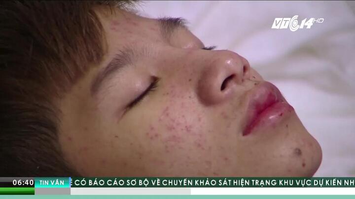 Sai lầm chết người khi tự chữa sốt xuất huyết tại nhà, phụ huynh nhất định phải biết