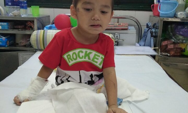 Bé 4 tuổi mất hai chân do sạt lở đất ở Sơn La: Tiếp tục cắt da hoại tử