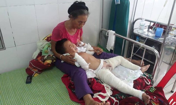 Nghịch xăng, bé trai 4 tuổi bị bỏng nặng