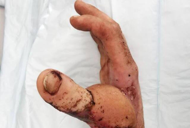 Cận cảnh bác sĩ bệnh viện Xanh Pôn chuyển đốt ngón chân thành... ngón tay