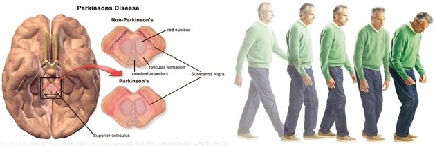 Dấu hiệu cho thấy bệnh Parkinson có thể chữa trị được